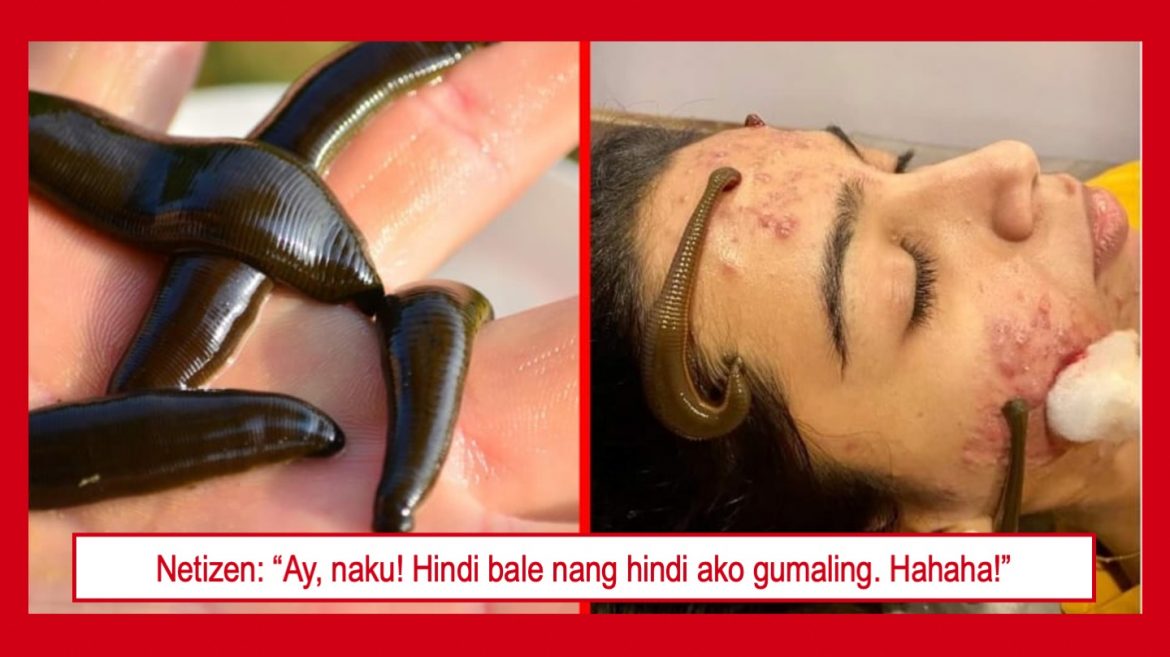 Linta, ginagamit na panggamot sa mga sakit gaya ng eczema, rayuma, at tigyawat?