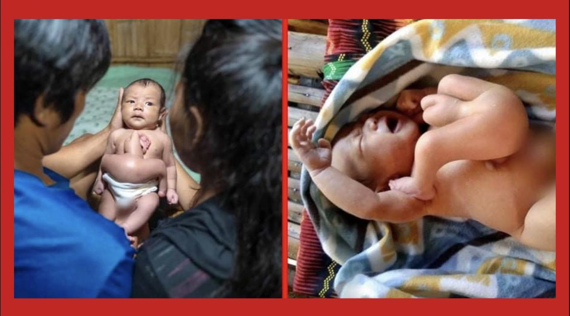 Bagong silang na sanggol, pinagkakaguluhan dahil sa kakambal nitong hindi nabuo